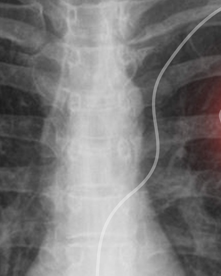 Ultrasound breakthrough enables rapid wireless charging of implantable medical devices