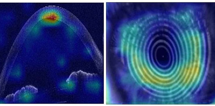 AI can spot which patients need treatment to prevent vision loss in young adults