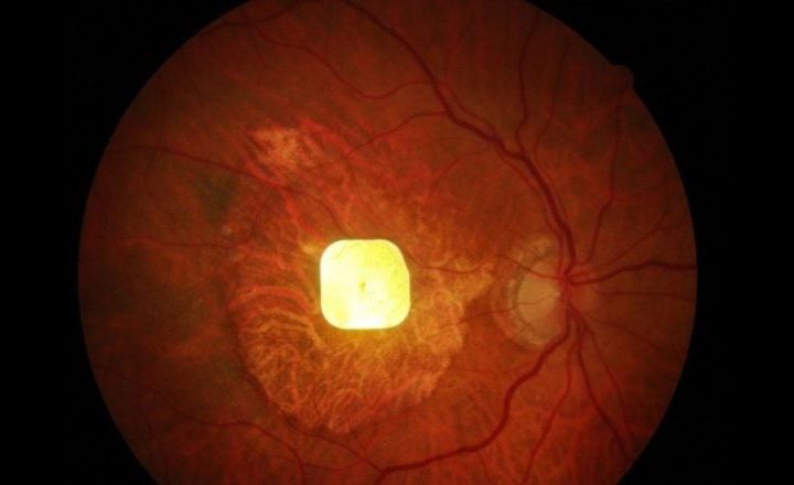 Solar-Powered Eye Implant Restores Reading Vision