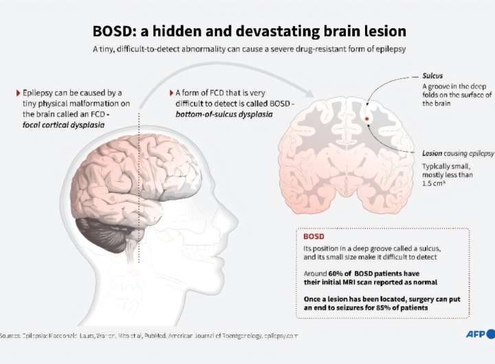 AI tool helps researchers treat child epilepsy