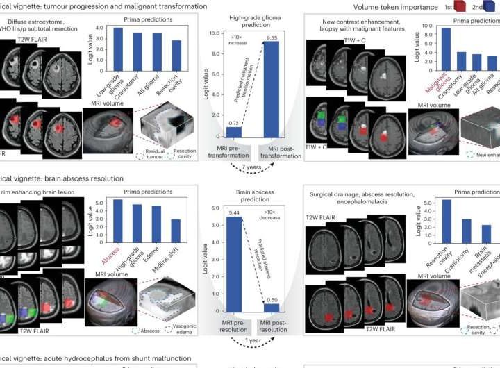 AI model reads brain MRIs in seconds, hitting up to 97.5% accuracy